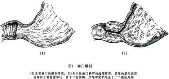 * 正常幽门和肥厚幽门。图源:土地公文库