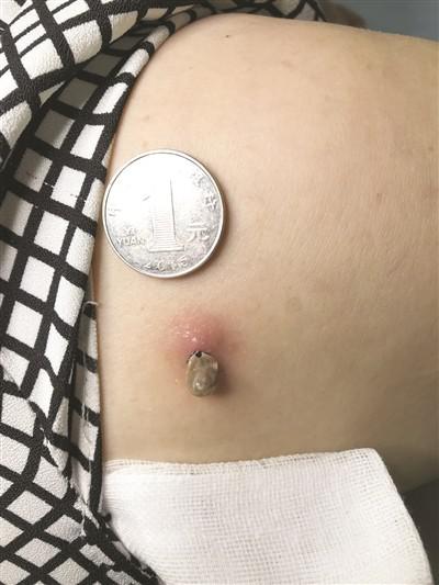 李阿姨被蜱虫叮咬的部位及伤口。