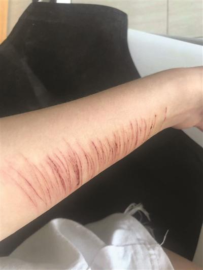 手臂上密密麻麻的伤痕记录着小婷一年多来的煎熬。