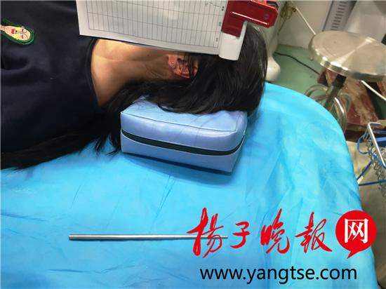 想催吐不锈钢筷却不慎滑进食道 多次模拟手术终取出