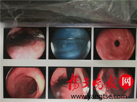 想催吐不锈钢筷却不慎滑进食道 多次模拟手术终取出