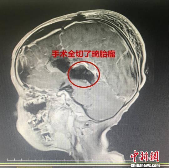 5岁男童脑里长头发 原是生出畸胎瘤