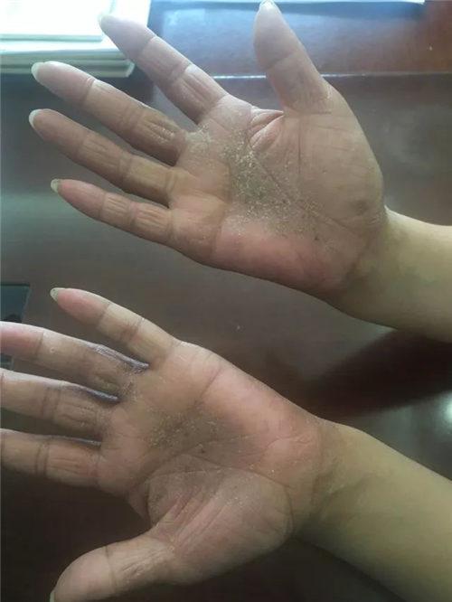 一个吸毒者的自白：从胳膊到指尖布满了黑线