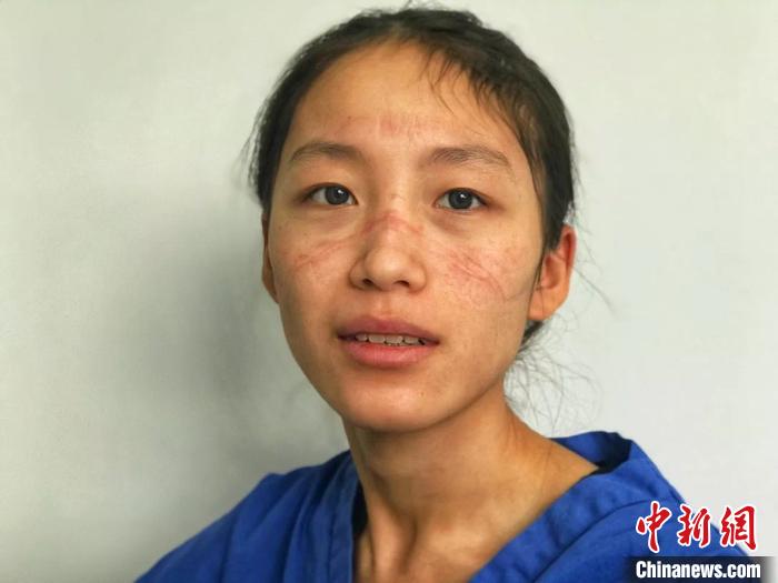 陈颖清秀姣好的面容上被勒出了深深的红色伤痕。浙大四院提供 浙大四院提供 摄