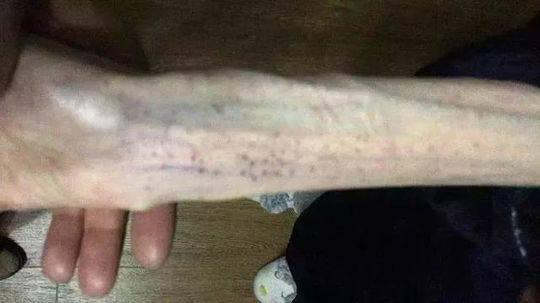 1米67才50斤！21岁女孩"自杀式减肥"险些成植物人