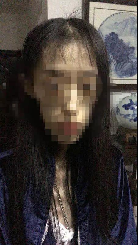 21岁女孩减肥至50斤 2次脑出血脑组织如60岁