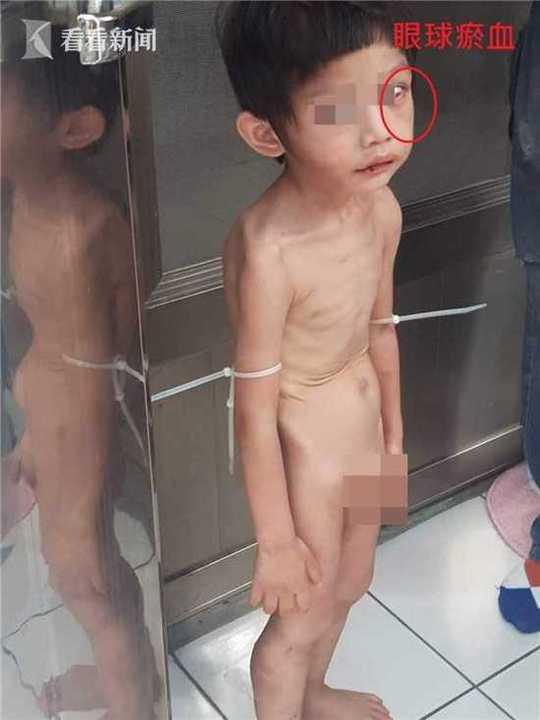 3岁男童遭父亲束带绑阳台 饿到皮包骨抓粪便吃