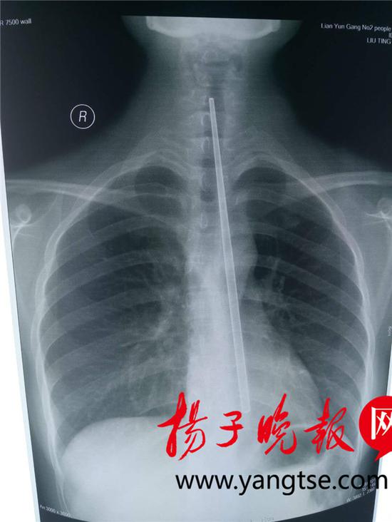 想催吐不锈钢筷却不慎滑进食道 多次模拟手术终取出