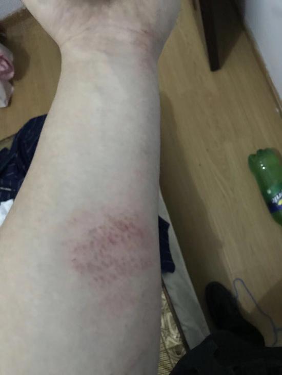 王榆钧双手胳膊被现场栏杆刮出多处伤痕