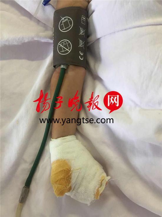 因被电击,两岁的乐乐左手三根手指烧伤非常严重。 刘威 摄