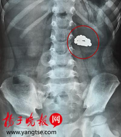 X片显示,5岁的毛毛腹中有一条形似“小蛇”的物体。