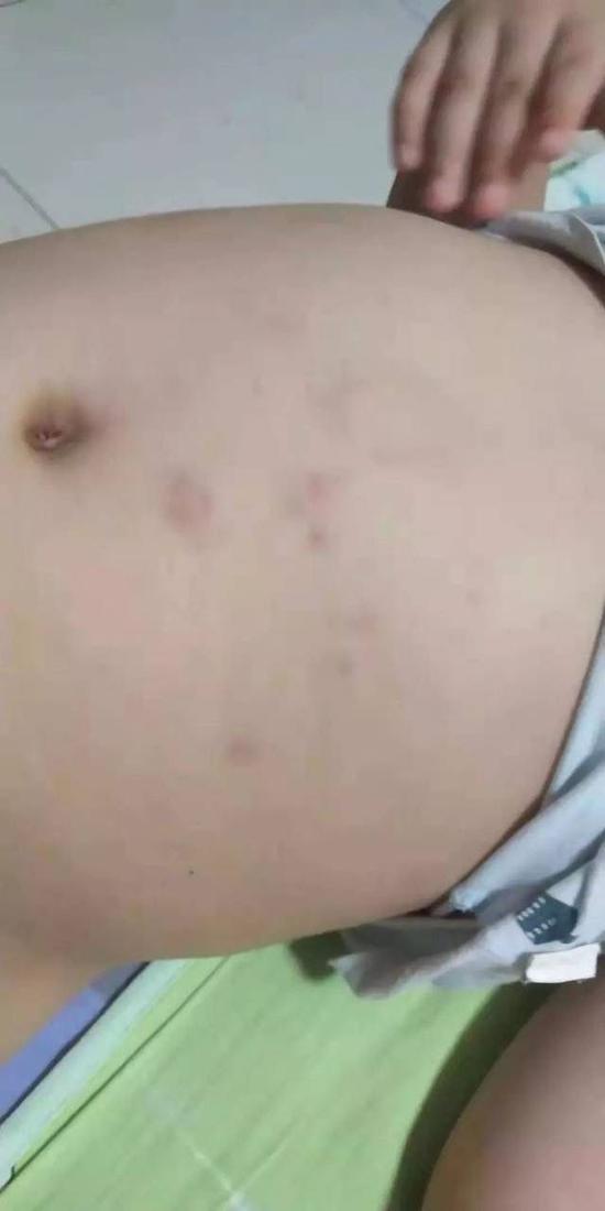 阳阳(化名)肚子上的红肿痕迹。受访者供