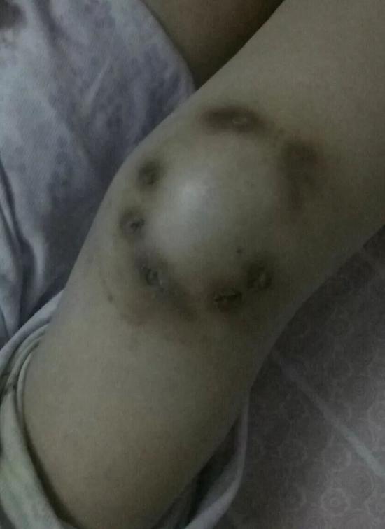 患者在“开口”之后反复感染