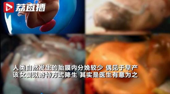 分娩@“哪吒”降世?女婴出生如透明巨蛋,医生:胎膜护体