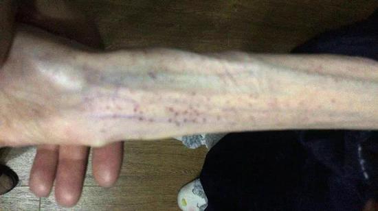 21岁女孩减肥至50斤 2次脑出血脑组织如60岁