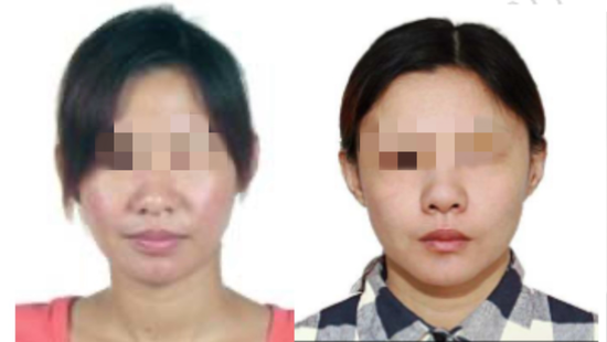 女嫌疑人隆鼻、定制双眼皮(左:整容前,右:整容后)