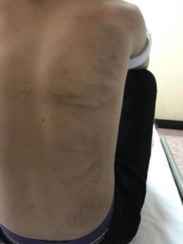 河北一初中生被同学打折肋骨 校长自责：我监管不力