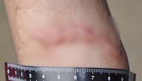 母亲对9岁女儿剪刀戳嘴、泼开水 被捕时称“为她好”