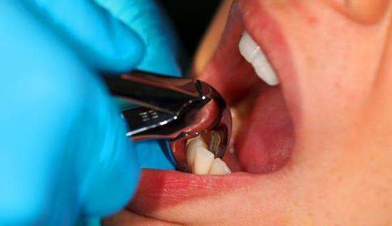 男子图省事用指甲钳拔牙 感染破伤风住进ICU