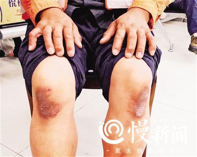 ▲跪在滚烫的地上作业是常事,有的工人膝盖“烫”出了茧疤。