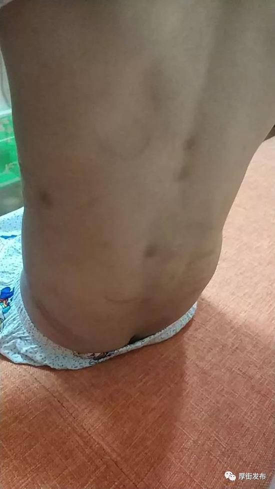 4岁男童遭单亲母亲虐待 全身多处受伤生殖器被打肿