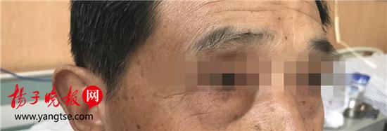 男子近半月眼袋突然变大 竟因为患上膀胱癌