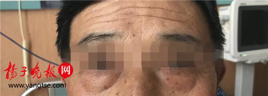 男子近半月眼袋突然变大 竟因为患上膀胱癌