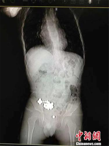4岁男童误吞20颗磁力珠 小肠“吸”成一团多处穿孔