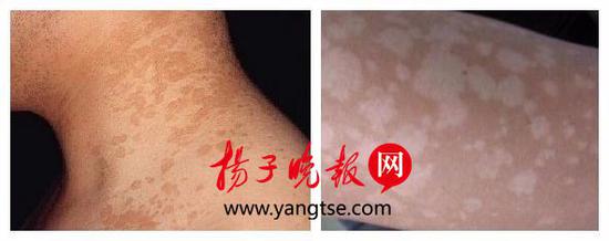 苏州25岁小伙夏日不及时洗澡 竟长出满身白斑