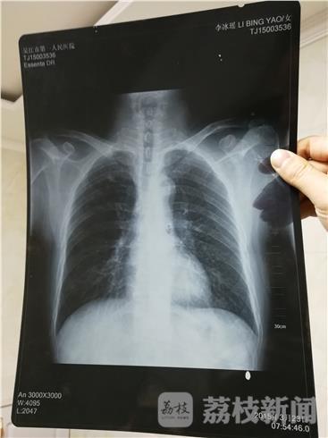 六旬男子患肺癌去世 患病前体检胸片"变"女性