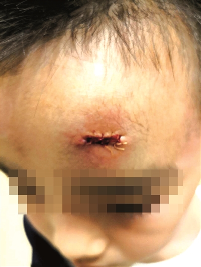 小贝额头缝针的伤口。家长供图