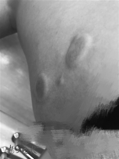 购买元祖雪月饼却被干冰冻伤 女顾客获赔1000元