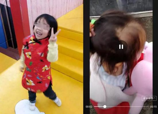 图左:毕某女儿服用无限极产品前,头发浓密且乌黑油亮;图右:毕某女儿服用无限极产品四个月后,头发枯黄,前额头发稀疏。 毕某供图