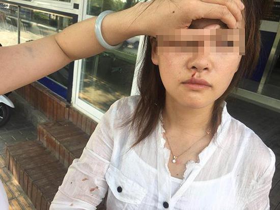 鹿女士嘴唇及眼底被打出血,脸上也有抓伤。当事人供图