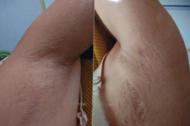 女子得“怪病”后指前夫对其注射激素 警方已介入