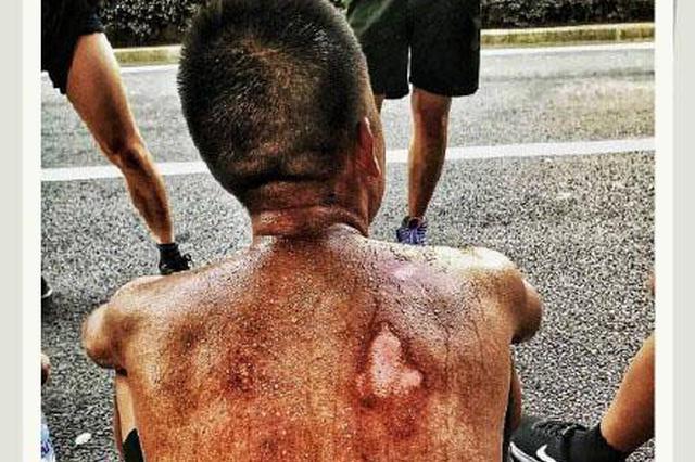 “不美”腿照和受伤背影刷屏了！两位主人公让网友泪奔