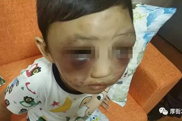 4岁男童遭单亲母亲虐待 全身多处受伤生殖器被打肿