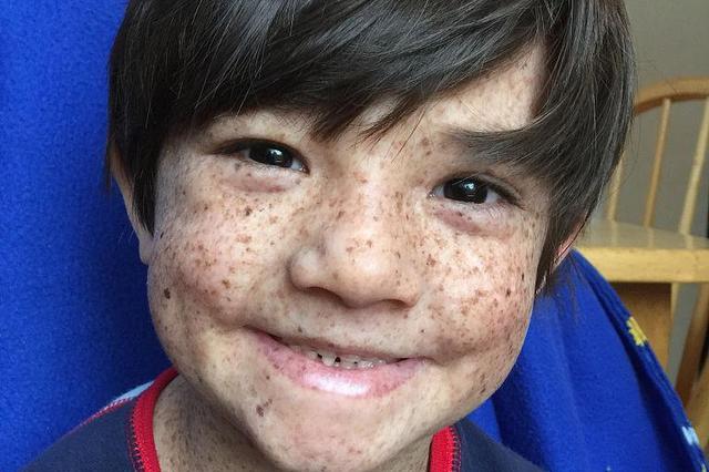 中国首批罕见病目录公布 白化病、血友病等121种疾病被纳入