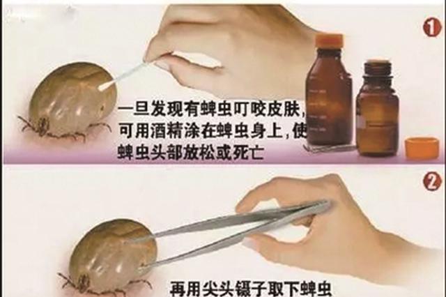 恐怖！一家三人被蜱虫咬伤 其中两人身亡