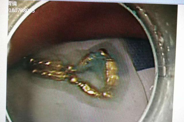 女子与丈夫吵架“吞金自杀” 胃镜取出10厘米金项链