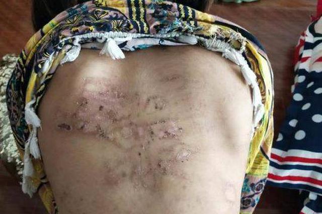 江苏邳州女童被家人虐待吊打 身上还有多处旧伤痕