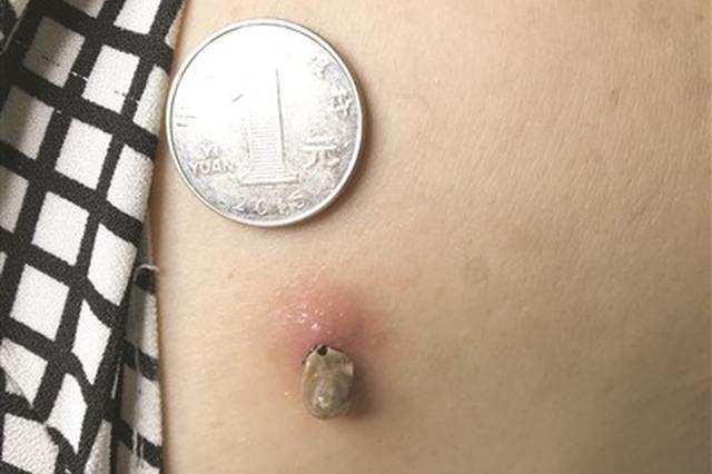 蜱虫附体7天 粗心阿姨误以为是“长痘”
