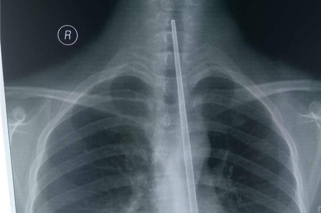 想催吐不锈钢筷却不慎滑进食道 多次模拟手术终取出