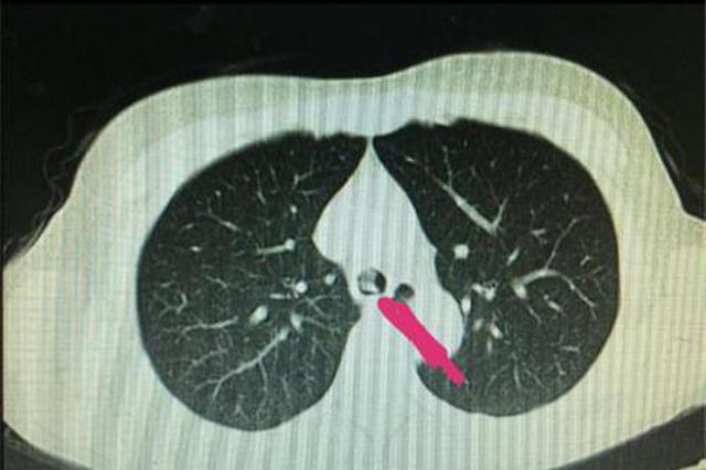 常州一女子喝杯水 一个不小心竟把假牙喝进气管