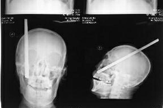 农民工被3米钢筋扎进头颅 3小时手术救回性命