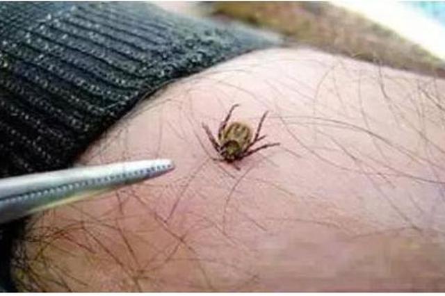 苏州一男子被蜱虫咬伤感染 不治身亡