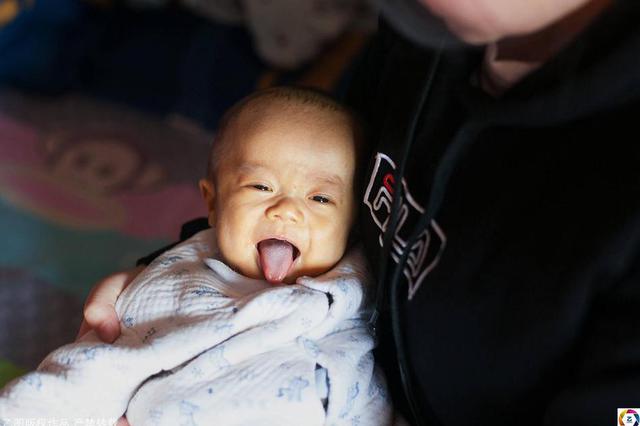 女子看《延禧攻略》 发现宝宝像金瞳五阿哥忙就诊