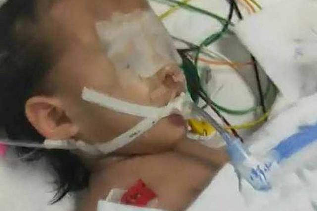 1岁女童疑遭母亲男友虐待全身是伤 救活率为零