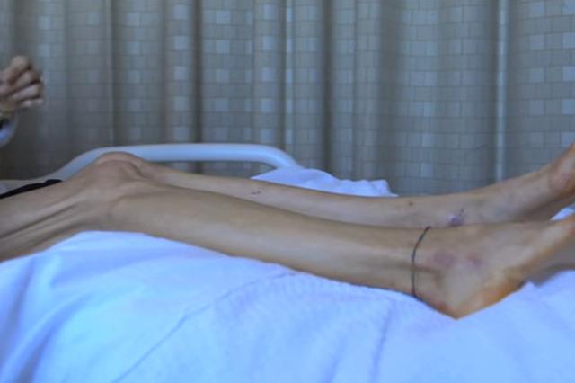 女孩为减肥一顿吃十五个包子再催吐 患上精神疾病