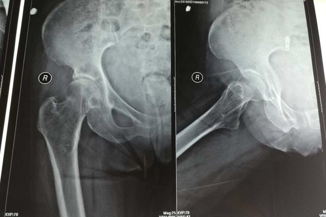 3名男子将8旬岁老人撞骨折 扔下2块钱就跑